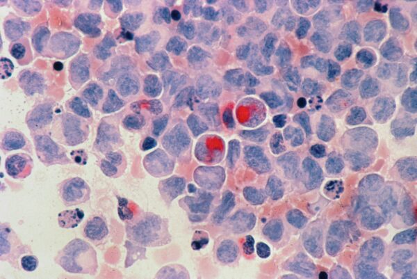 Cancer Cells Unsplash Dominik Scherrer